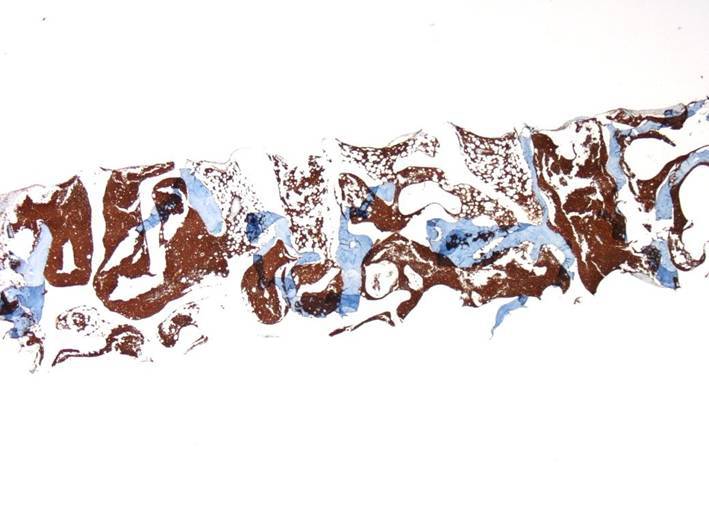 third bone marrow biopsy CD10